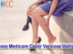 Does Medicare Cover Varicose Veins?