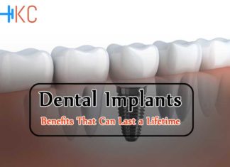 Dental Implants